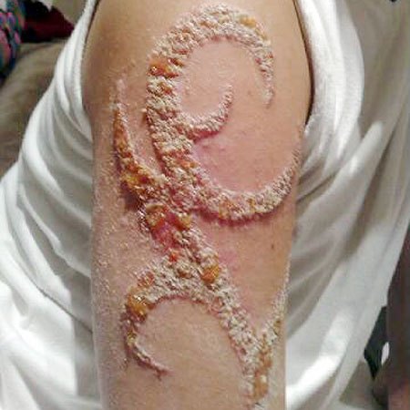 black-henna-scar-2011